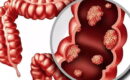 腸癌 (遺傳性腸病) 1