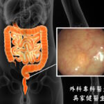 直腸神經内分泌瘤（Neuroendocrine tumor）