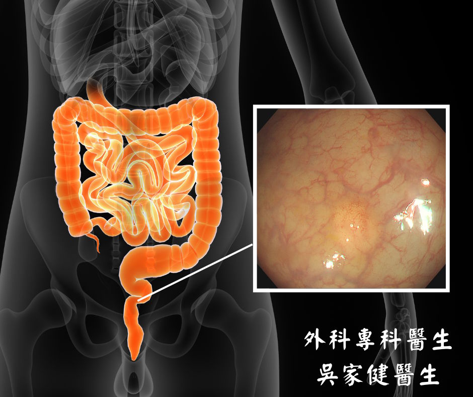 直腸神經内分泌瘤（Neuroendocrine tumor）