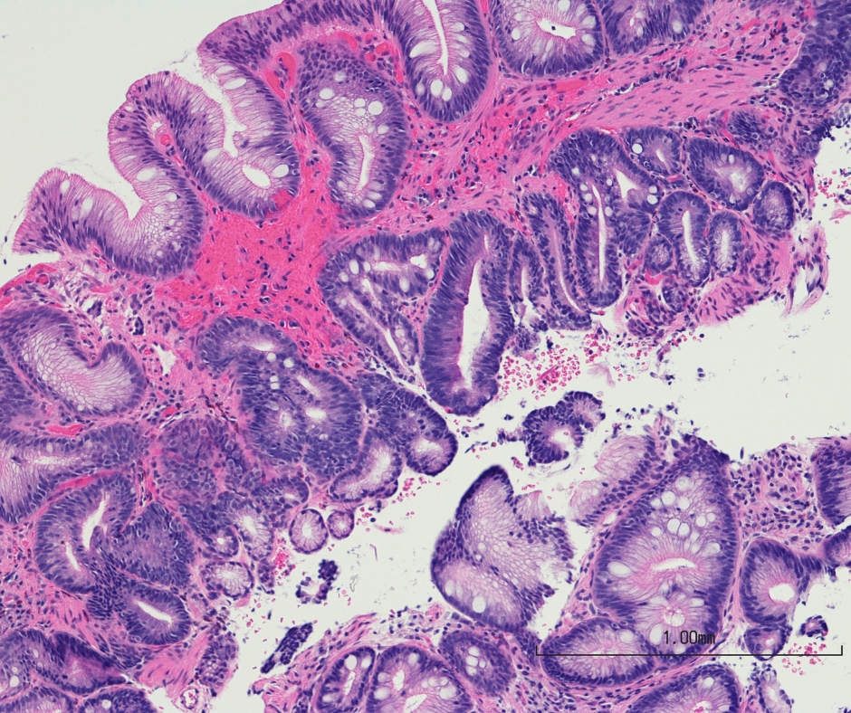 腸化生是誘發胃癌的重大元兇？醫生解析4大主要成因！