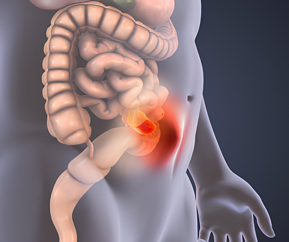 小腸氣會出現在腹股溝下方？認識小腸氣5種形態！