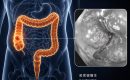 大腸癌（Colorectal cancer）